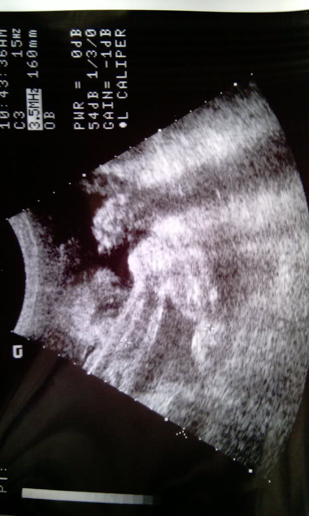 What does a cleft lip look like on ultrasound? BabyCenter